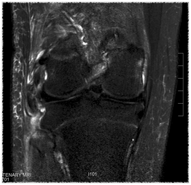 ACL LCL MRI 2